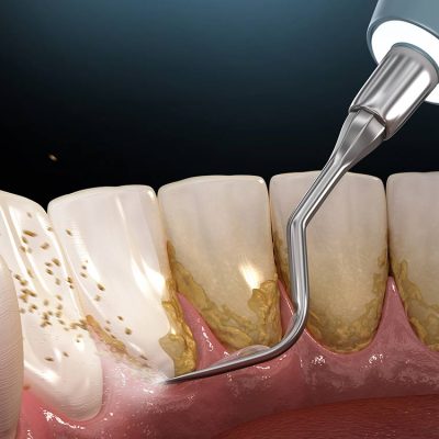 Fase higiénica periodental