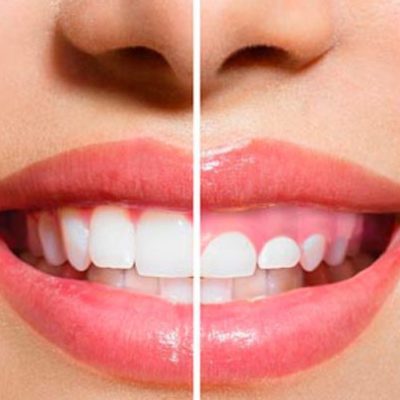 Gingivectomia (Corte de encías)