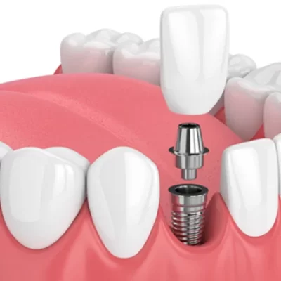 Profesionales en implantes dentales en bogota