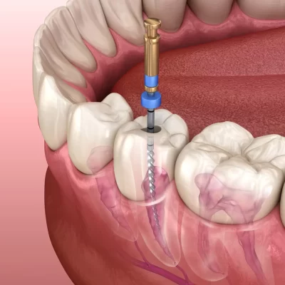 Clínica Dental #1 en Tratamientos de endodoncia en Bogotá