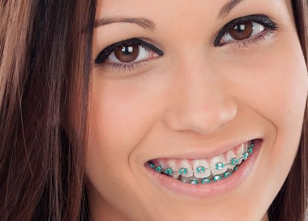 ortodoncia y brackets dentales en Bogota